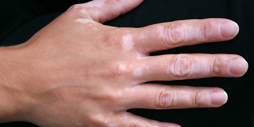 vitiligo image vitiligo image