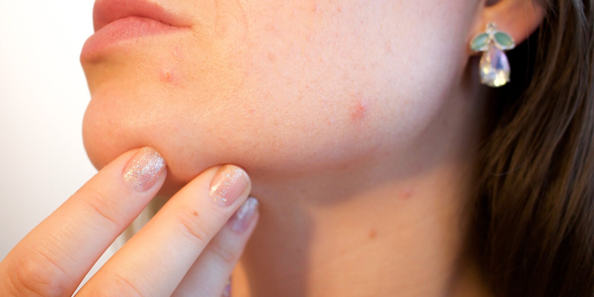 acne 1606765 1920 acne 1606765 1920