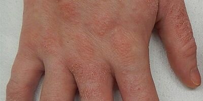 blog-eczema-img hand with eczema