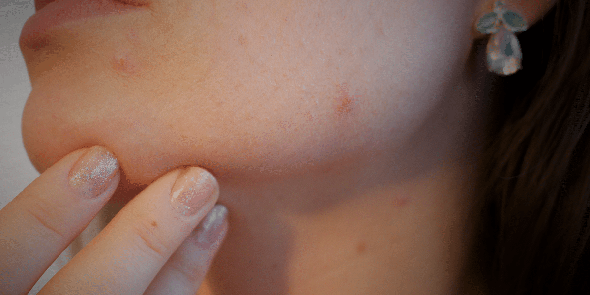 blog-adult-acne adult acne at alaska family dermatology