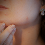 adult acne at alaska family dermatology