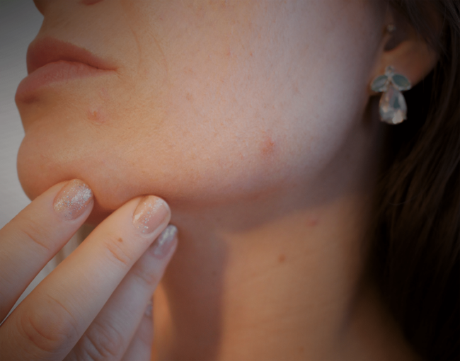 blog-adult-acne adult acne at alaska family dermatology