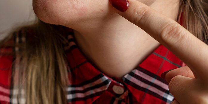 akfamily-acne-photo Acne photo