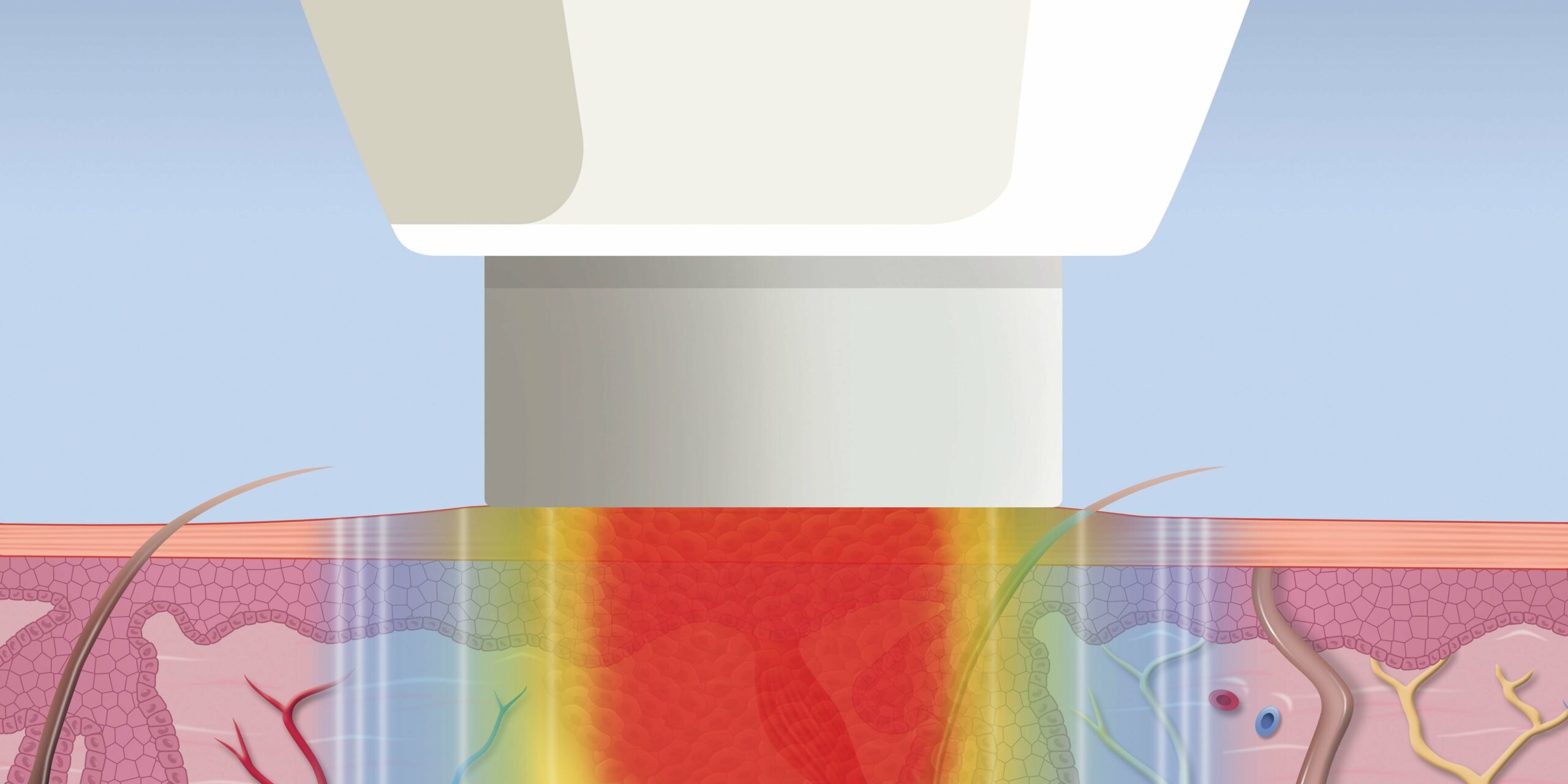 swift-treatment-graphic Swift wart treatment graphic