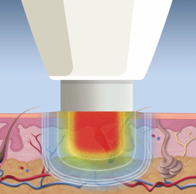 swift-treatment-graphic Swift wart treatment graphic