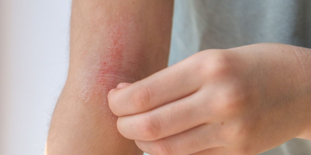 Arm with eczema