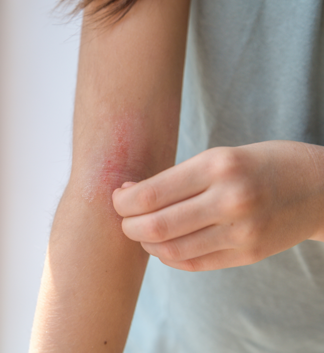 Arm with eczema