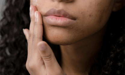 blog-6-3-25-acne Acne image