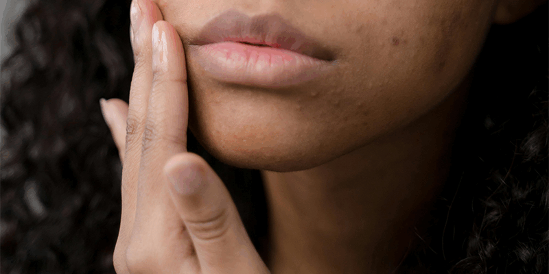 blog-6-3-25-acne Acne image