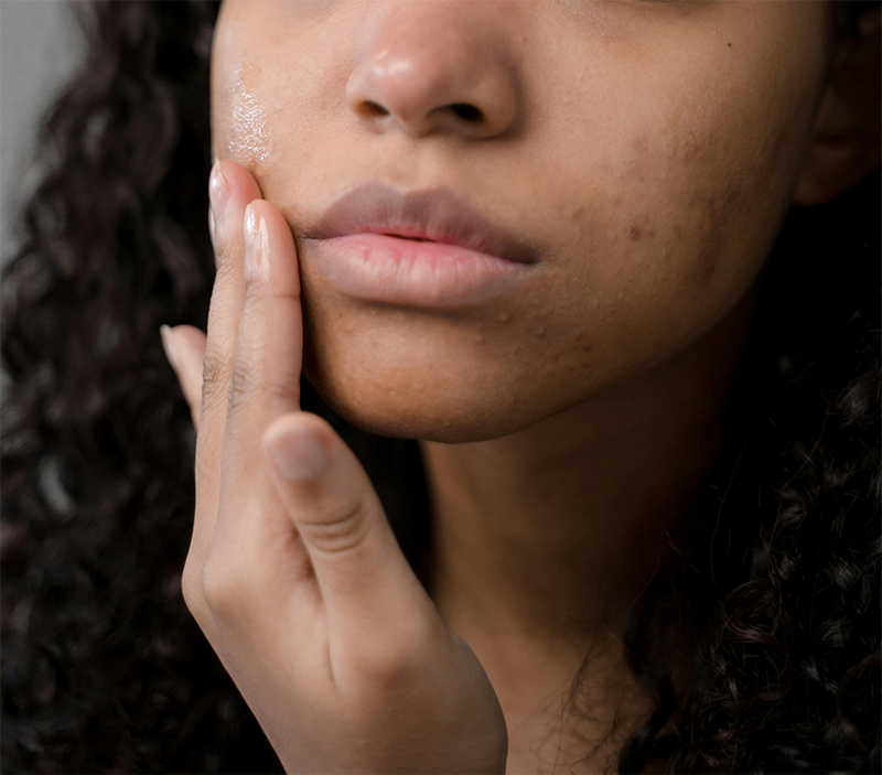 Acne image