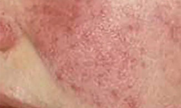 rosecea